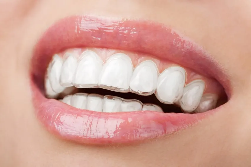 Living with Clear Aligners – Tips & Tricks