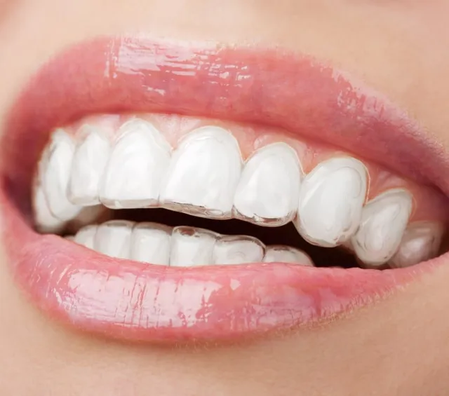 Invisalign