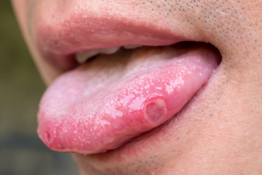 What Do Tongue Ulcers Mean