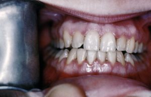 Trench Mouth- Causes, Symptoms and Treatment